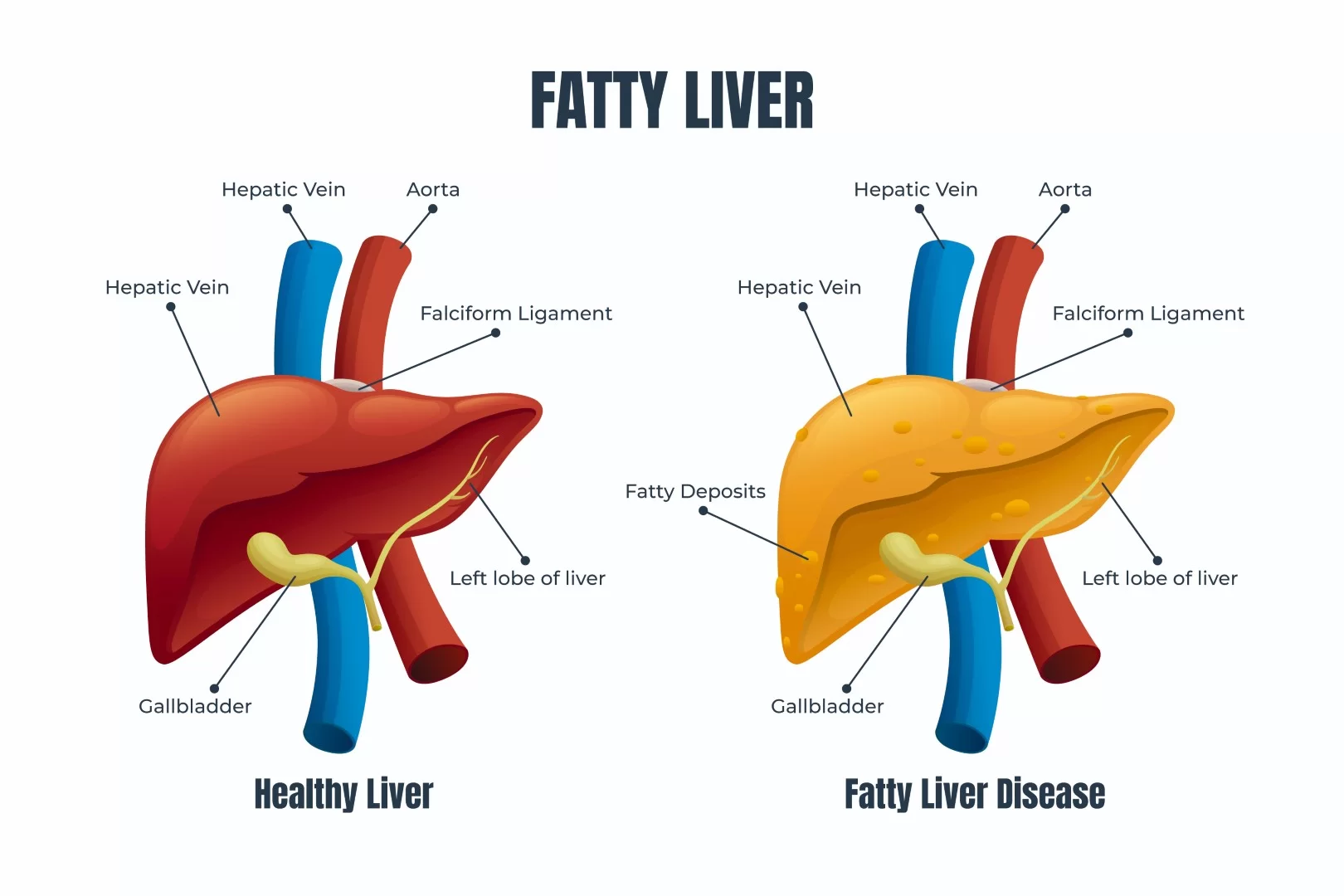 45m People Have Fatty Liver In Country Experts News is-it-safe-to-eat-liver-during-pregnancy-babycenter