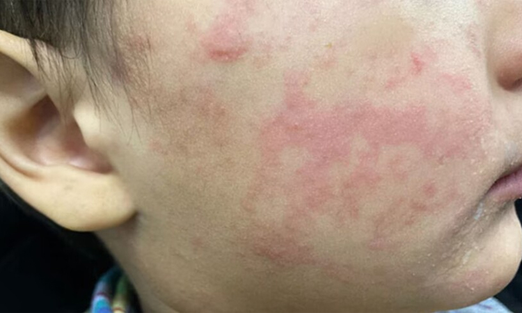 Mexico reports 22 measles cases after US outbreak