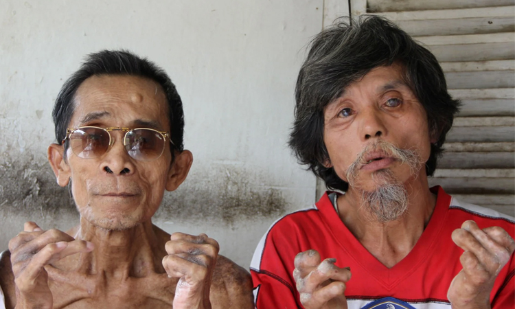Patients with leprosy face lasting stigma in Ethiopia