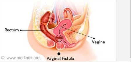 Early identification of obstetric fistula patients underscored