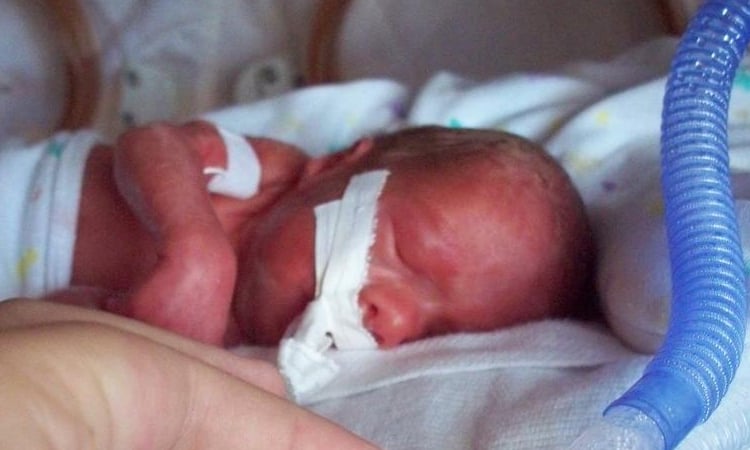 Premature birth: leading cause of deaths for children under 5