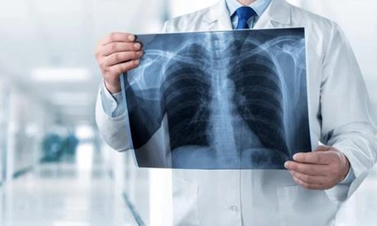 Researchers develop nanotube-based model for early lung cancer detection