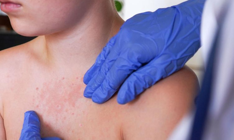 US measles epidemic grows with South Carolina outbreak