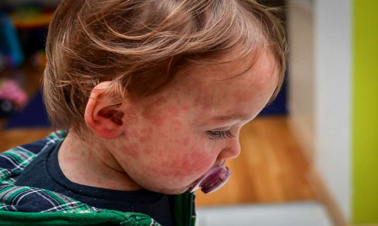 When illness strikes: how proper nutrition helps children fight measles and chickenpox