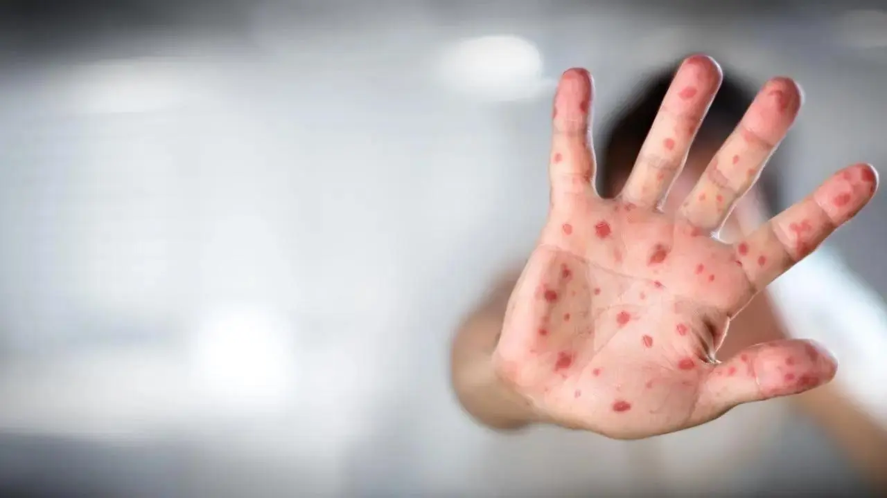 Experts urge caution for children during Eid travel amid measles risks 