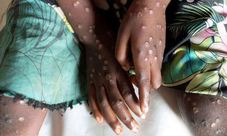 আফ্রিকা এমপক্স জরুরি পরিস্থিতির কবলে নেই : আঞ্চলিক স্বাস্থ্য প্রধান