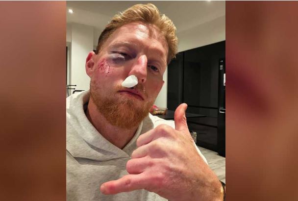 বলের আঘাতে রক্তাক্ত স্টোকসের মুখ