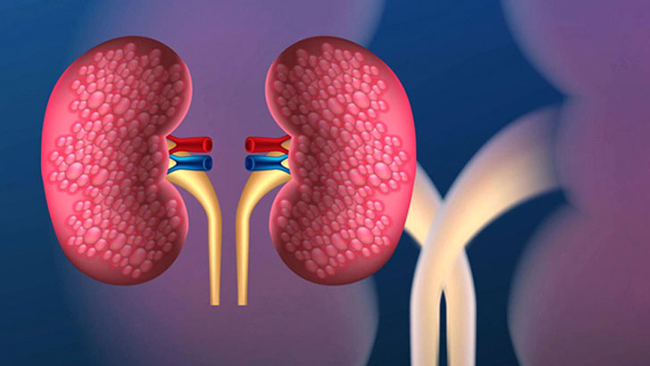 কিডনি রোগ প্রতিরোধে সচেতনতা ও নিয়মিত পরীক্ষা জরুরি: বিশেষজ্ঞদের অভিমত 