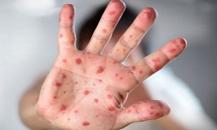 হামে আক্রান্ত আরো ২ জনের মৃত্যু, আক্রান্ত ৭৮৭