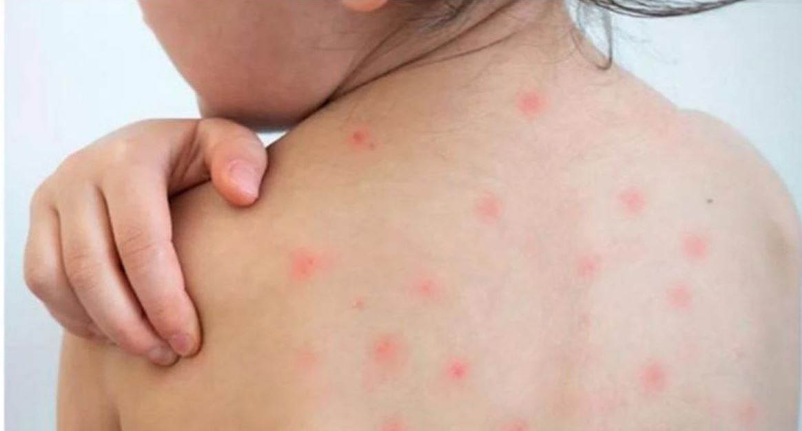 দেশে গত ২৪ ঘণ্টায় হাম রোগে কেউ মারা যায়নি