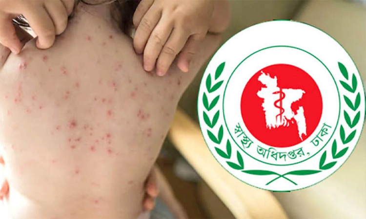 হামের উপসর্গ নিয়ে আরও ৪ জনের মৃত্যু, আক্রান্ত ৯৪২
